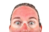 Top half of a sunburned face, with white rings around the eyes.