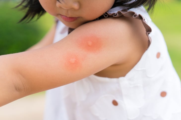 Child with mosquito bites on arm.